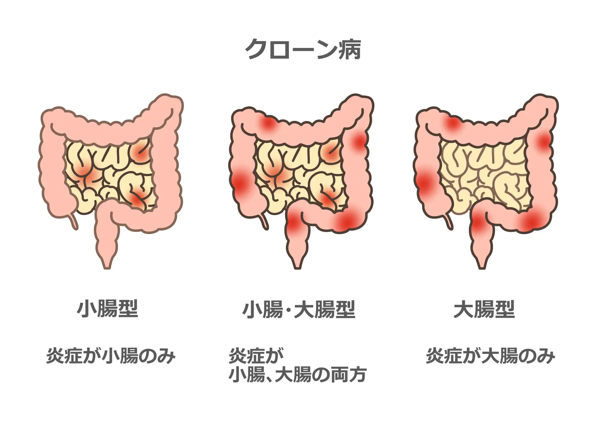 クローン病とは