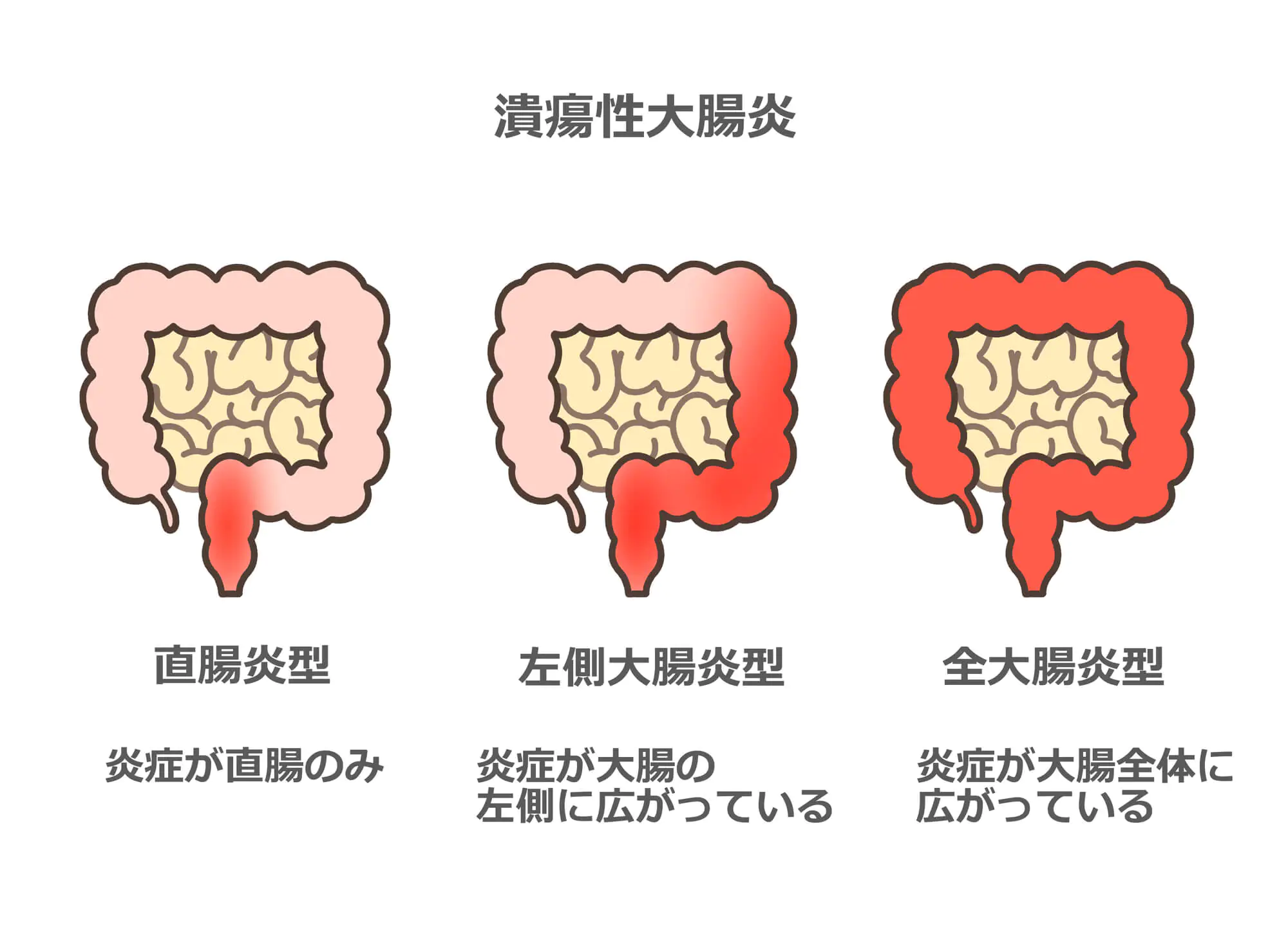 潰瘍性大腸炎とは